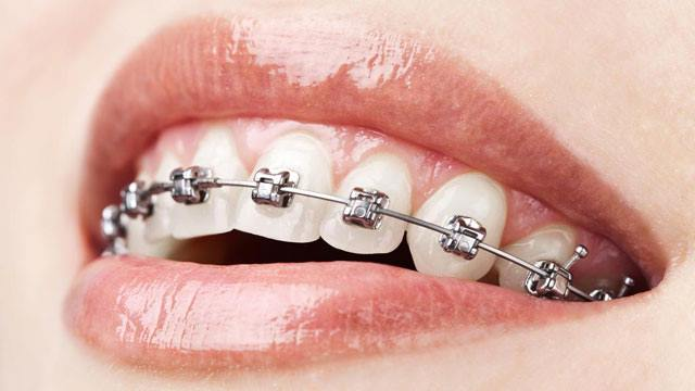 Take advantage of our discount on braces placement (both jaws) at Deka Dent. image 0