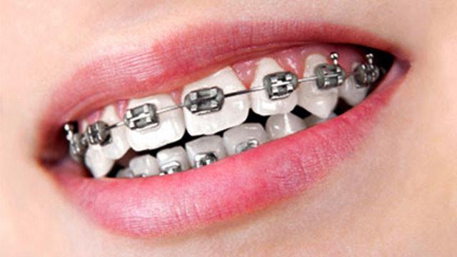 20 ლარად, 35%-იანი ფასდაკლების Swooper Code-ი მეტალის ბრეკეტებზე  «Extra Dent-ისგან» image 0