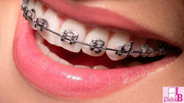 20 ლარად, 30%-იანი ფასდაკლების Swooper Code-ი მეტალის ბრეკეტებზე (ორივე ყბა) სტომატოლოგიურ კლინიკაში «IB Dent» 0
