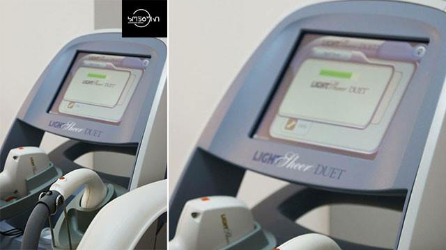 5 ლარად, 65%-მდე  ფასდაკლების Swooper Code-ი დიოდურ ეპილაციაზე Lumenis-ის 2017 წლის აპარატით ესთეტიკის ცენტრში «კონტური» image 2