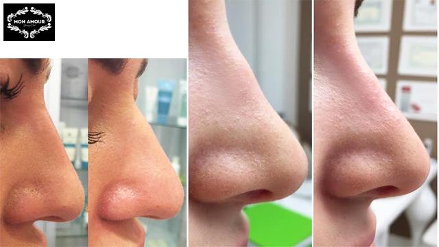 20 ლარად, 54%-იანი ფასდაკლების Swooper Code-ი ცხვირის პლასტიკაზე ოპერაციის გარეშე სილამაზის სალონში «Mon Amour» image 0